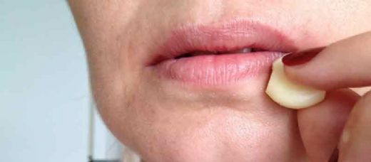 Dudak Uçuklamasına Ne İyi Gelir?