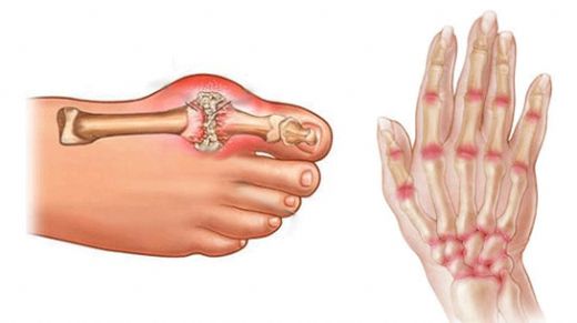 Eklem Ağrılarına Ne İyi Gelir?
