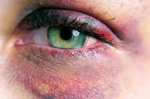 Göz Morarmasına Ne İyi Gelir?