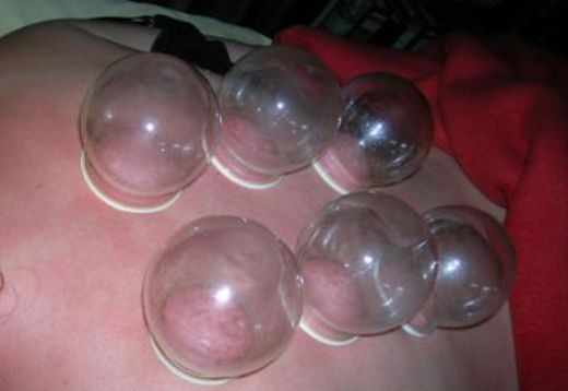 Hacamat Neye İyi Gelir?