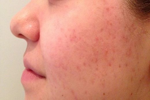 Sivilce İzlerine Ne İyi Gelir?