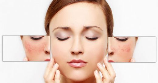 Yüzdeki Alerjiye Ne İyi Gelir?