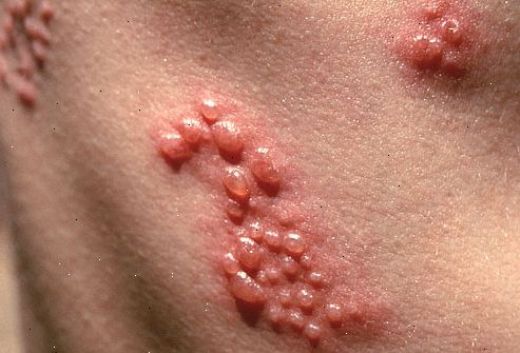 Zona Hastalığına Ne İyi Gelir?